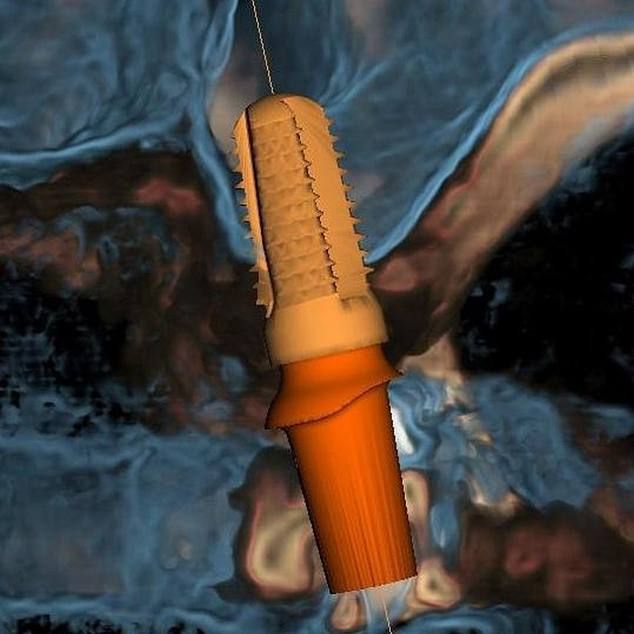 Implantatlager-Analyse als 3D-Implantat