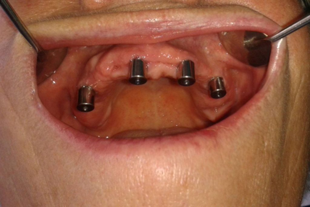 oralchirurgie berlin all on 4 op